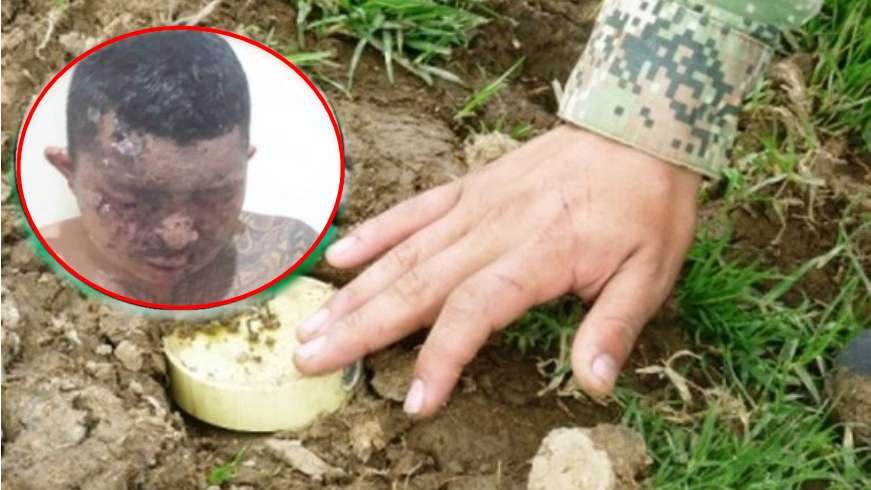 Tras explosión de mina antipersona, campesino perdió la vista