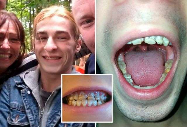 Joven perdió sus dientes por consumir seis latas de bebidas energizantes al día