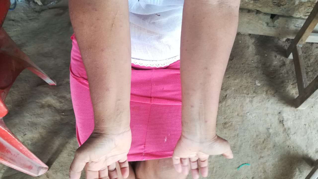 Habitantes de tres corregimientos de Montería afectados por extraño brote en la piel