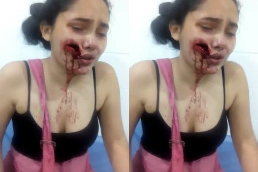 Mujer que sufrió fuerte golpiza y quedó con el rostro desfigurado en Planeta Rica pide justicia