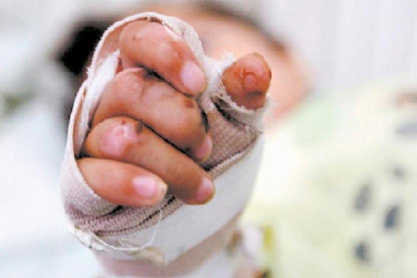 Niño de dos años murió en Montería tras manipular olla de agua hirviendo