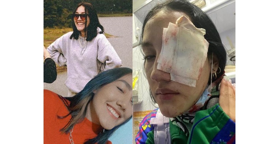 Leidy Cadena, perdió un ojo tras ataque del Esmad durante Paro Nacional en Bogotá