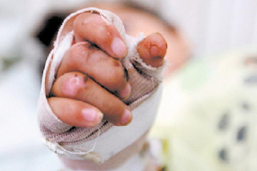 A niño de 10 años le amputaron dos dedos tras manipular pólvora que encontró en la calle