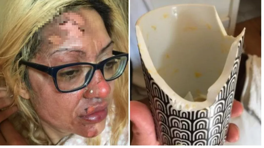 Tras utilizar un truco de TikTok para cocinar, mujer resultó quemada en el rostro con un huevo