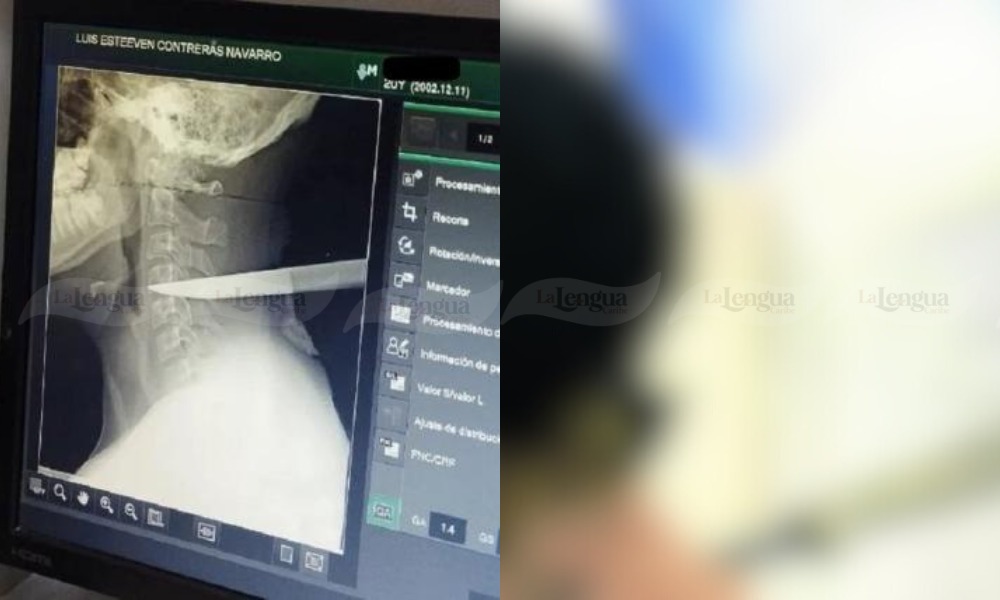 ¡Impresionante! A joven le incrustaron un cuchillo en el cuello y sobrevivió de milagro