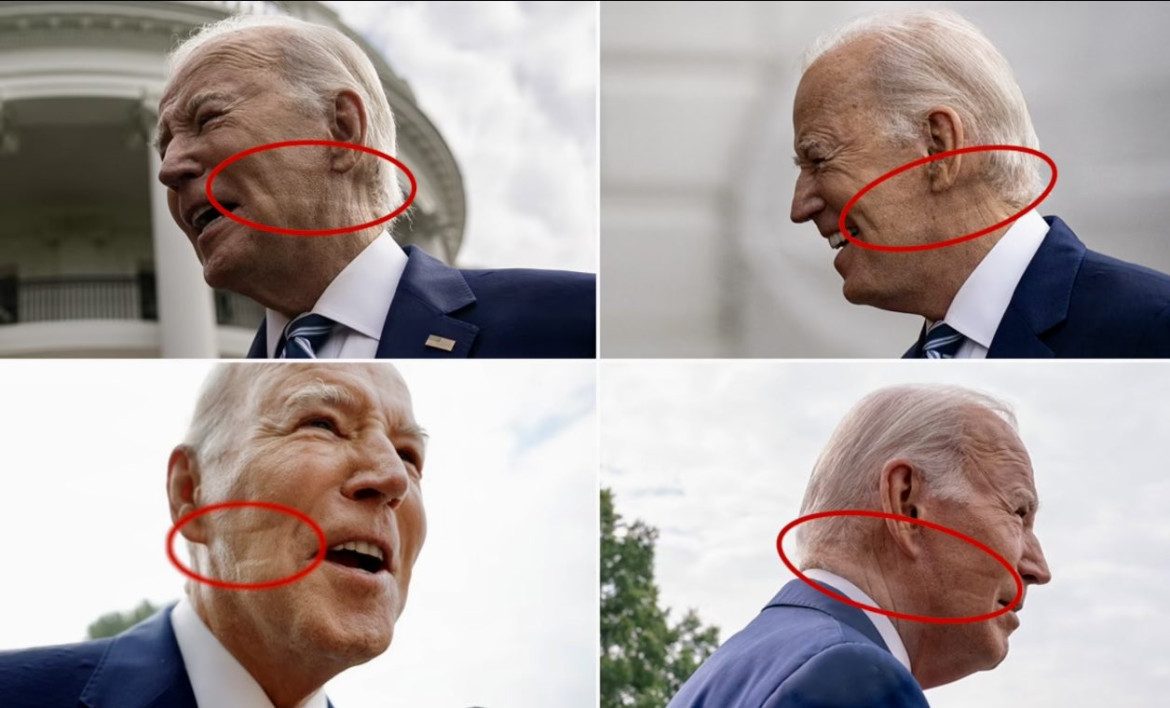 Joe Biden padece de apnea del sueño y apareció con extrañas marcas en su rostro