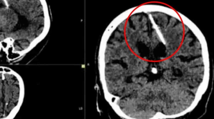 Abuelita descubre que tuvo una aguja enterrada en el cerebro durante 80 años