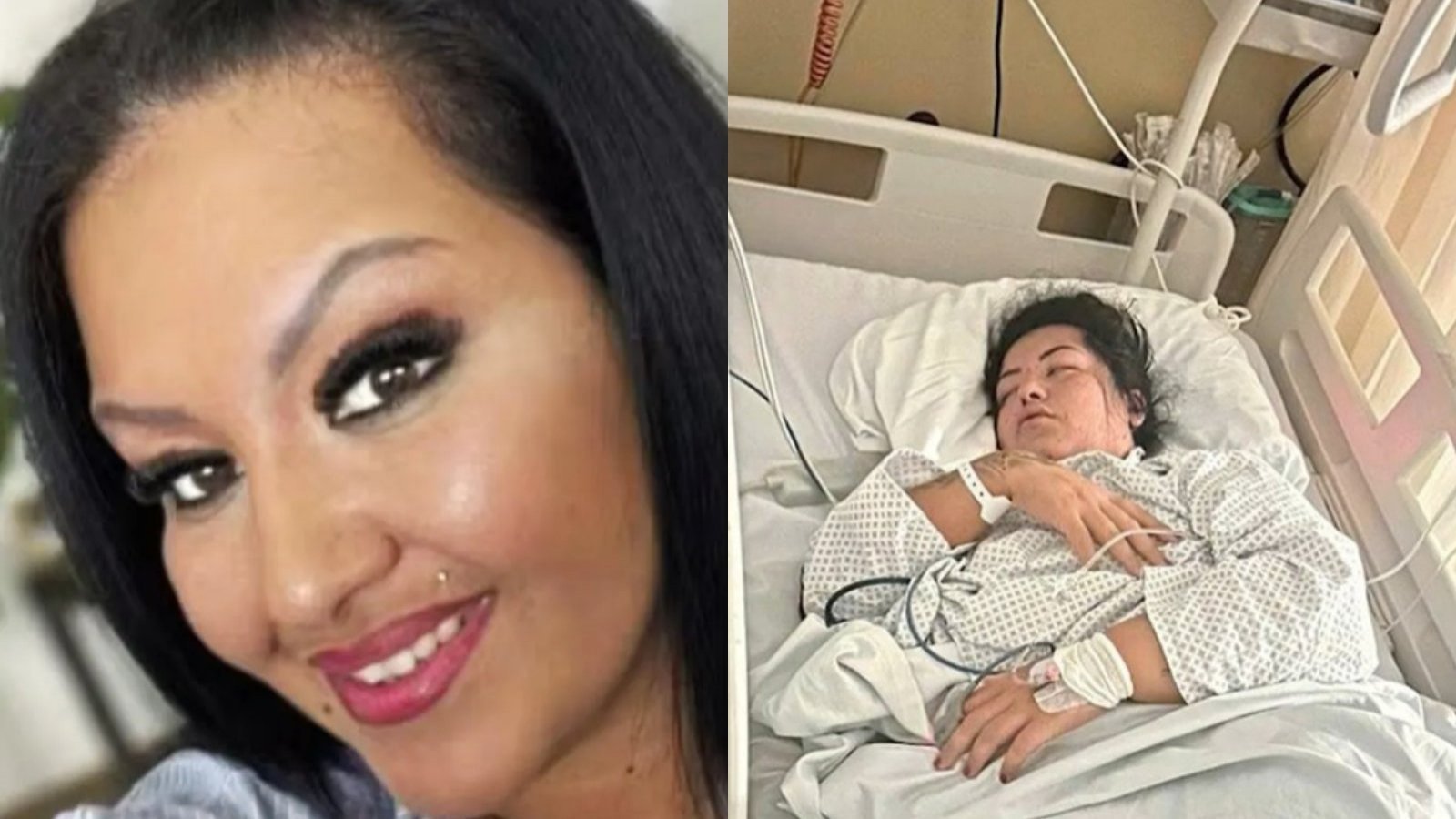 Mujer de 28 años murió tras aplicarse relleno en los labios