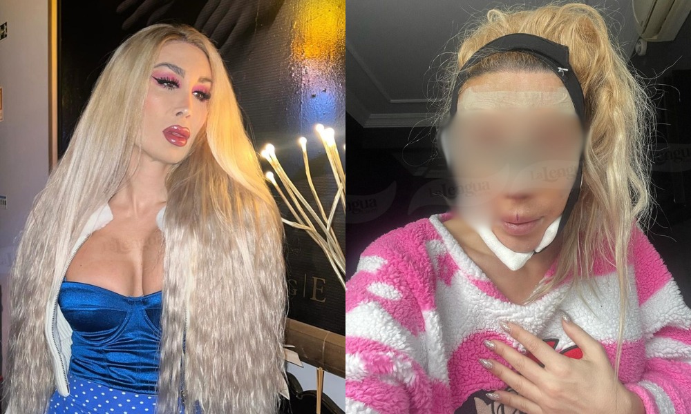 “Se vio apurada”: ‘Influencer’ se hizo seis cirugías y quedó ciega por dos días