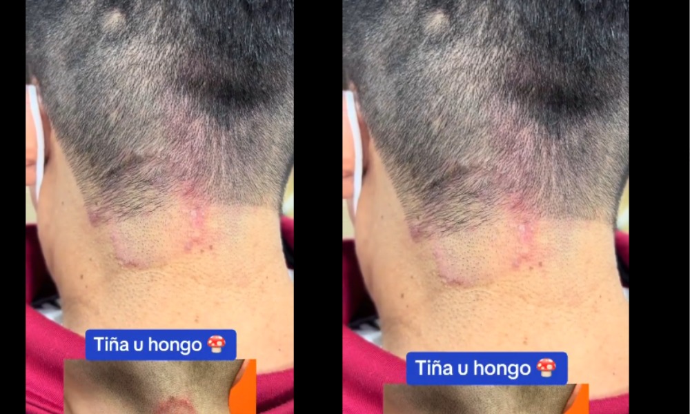 ¡Hombres muy atentos! Esto pasa cuando no desinfectan los utensilios de la barbería